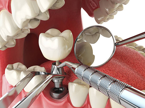 Best Broken or Chipped Tooth Repair in Hoisington, KS